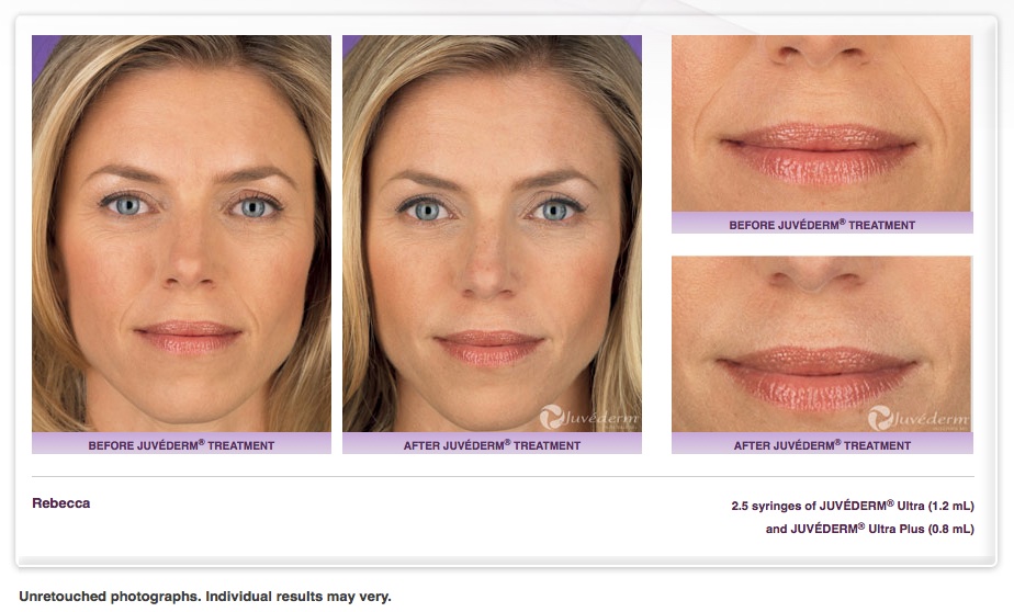 Juvederm Fillers At Laser Skin Institute Chatam Nj