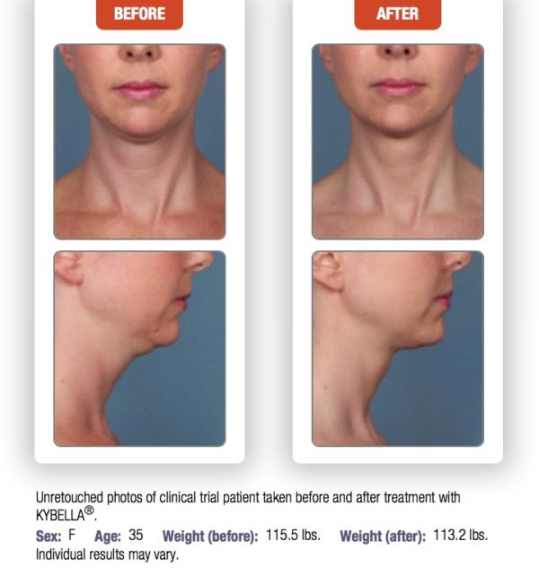 Kybella Treatments At Laser + Skin Institute | Chatam, New Jersey