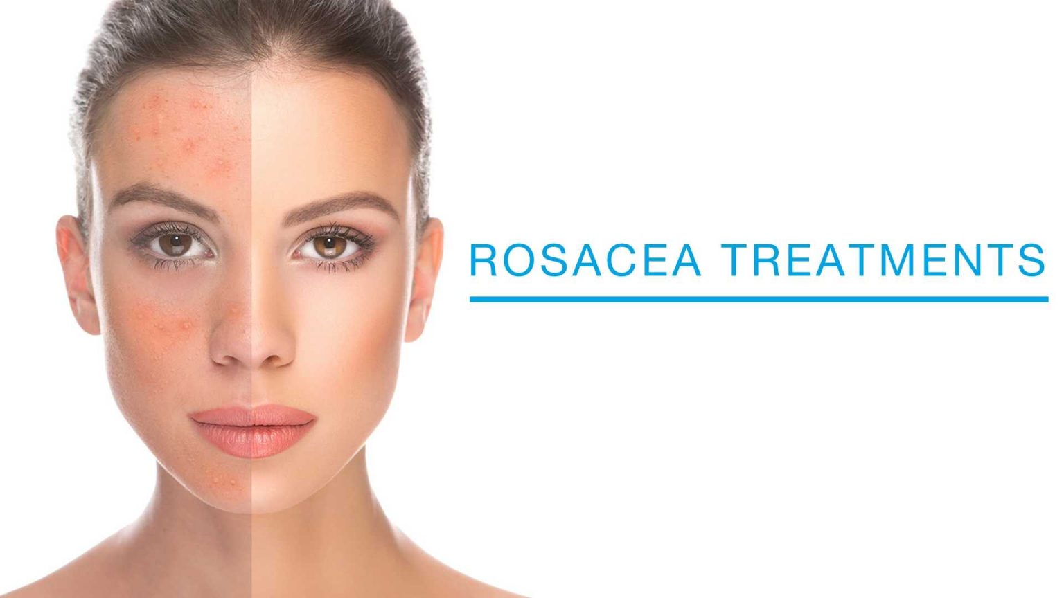 Rosacea Treatments At Laser Skin Institute Chatam Nj 