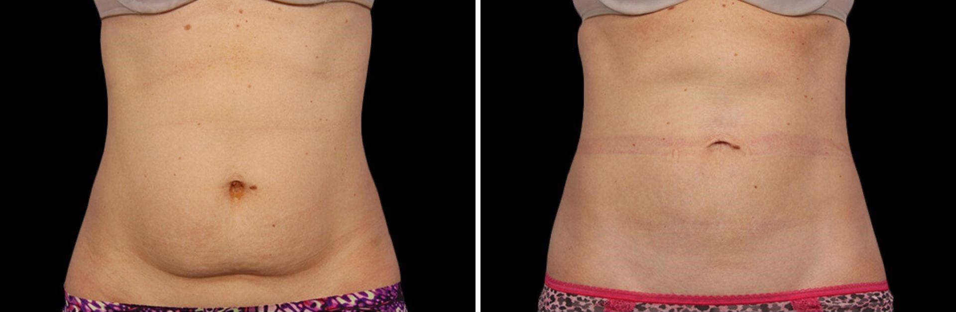 Cryolipolysis Before and After - Photos and videos